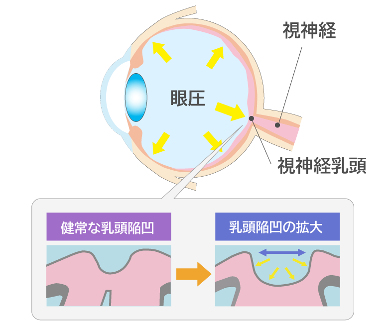 視神経乳頭陥凹拡大