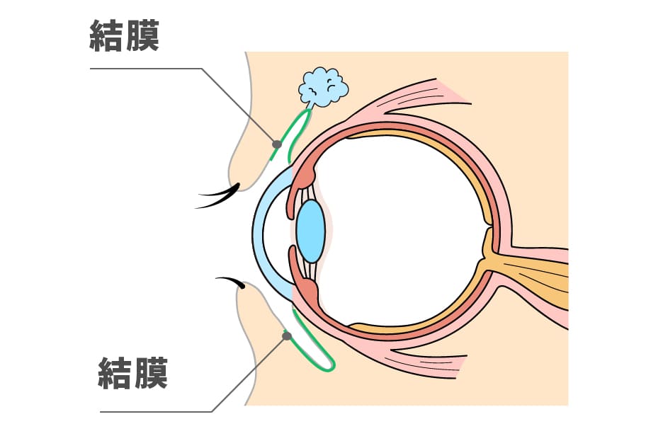 アレルギー性結膜炎