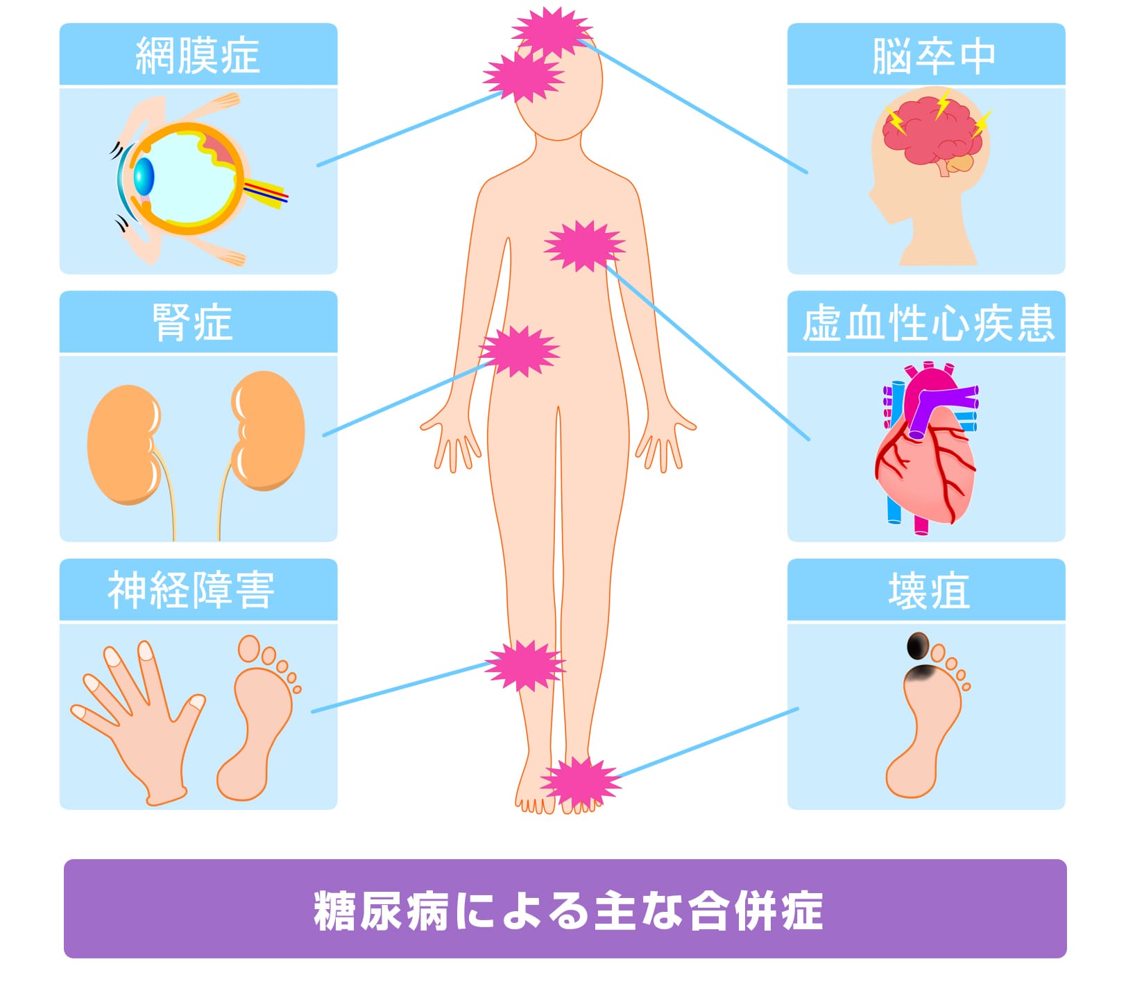 糖尿病の合併症