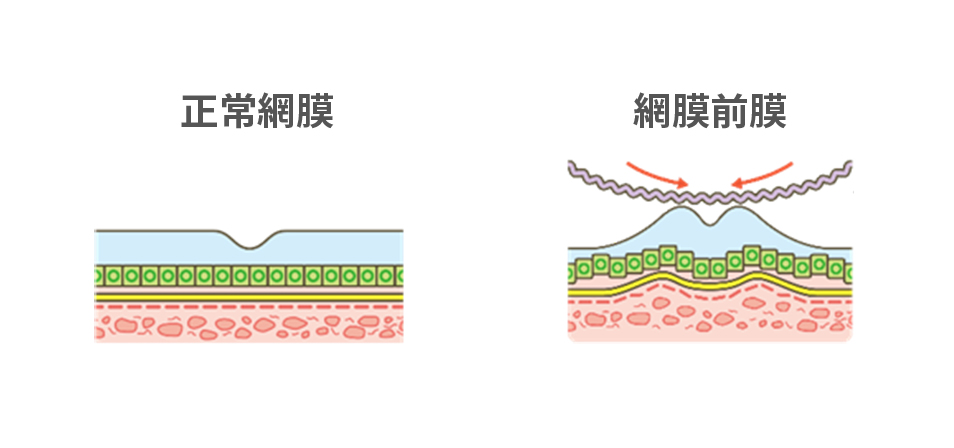 網膜前膜