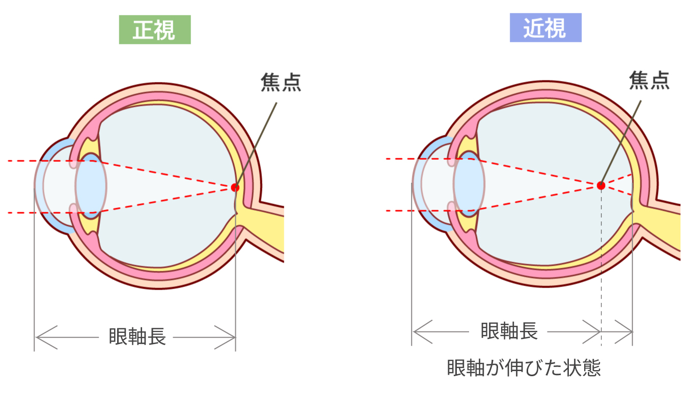 近視とはピントが合わなくなる状態