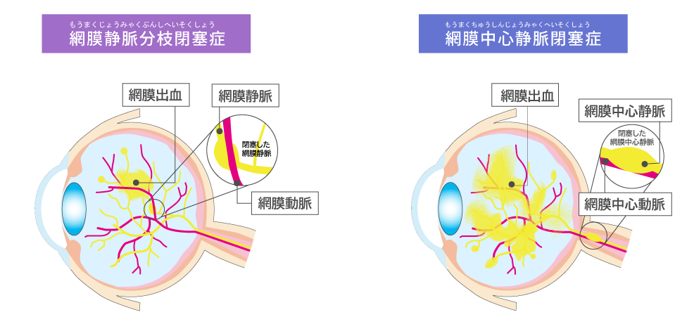 網膜静脈閉塞症